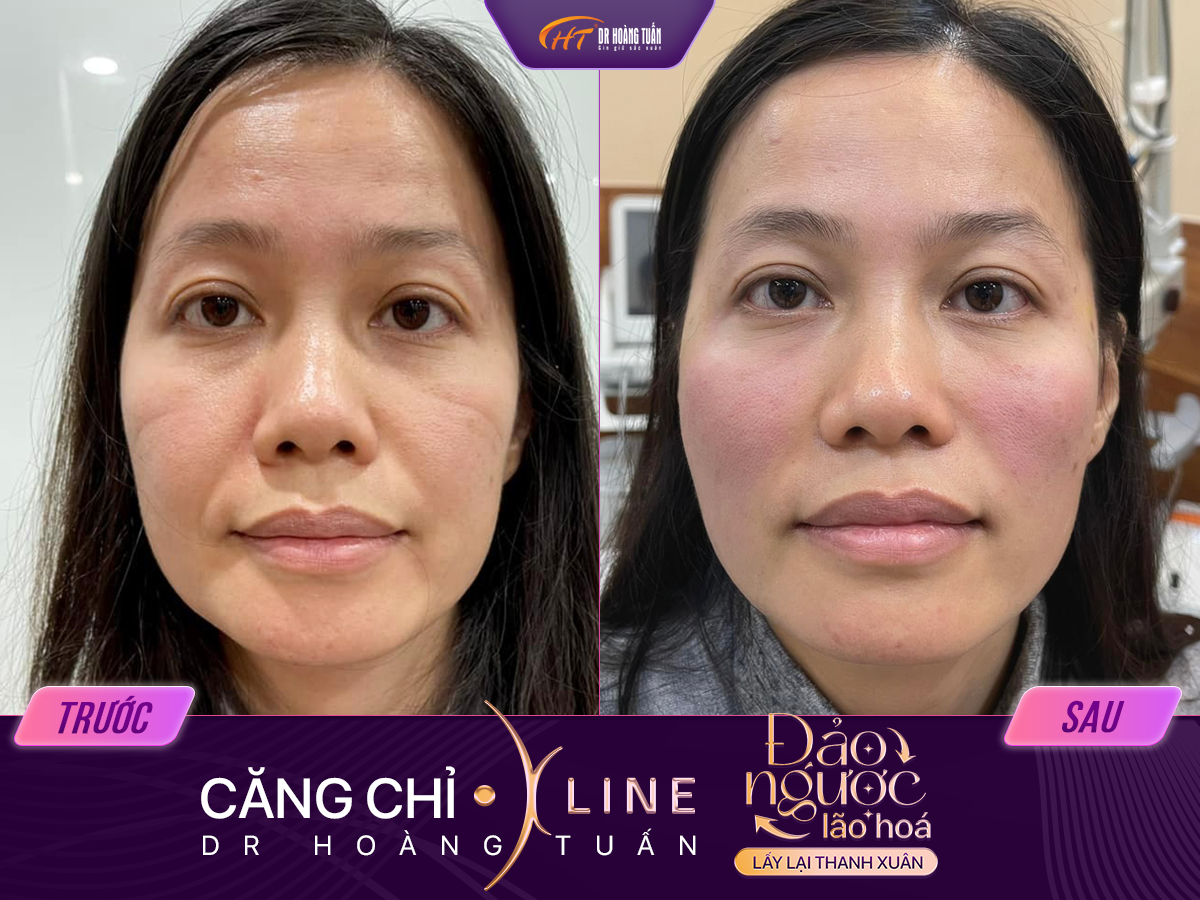 Kết quả căng chỉ xline